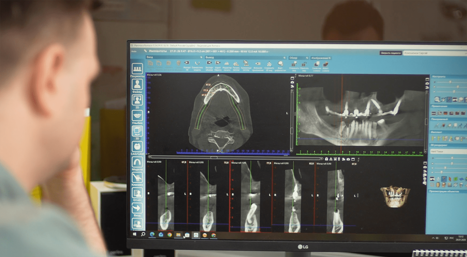  Имплантация All-On-4