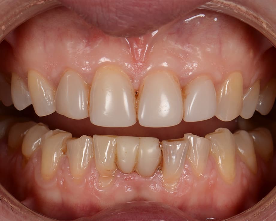 Пресс-керамика E.max