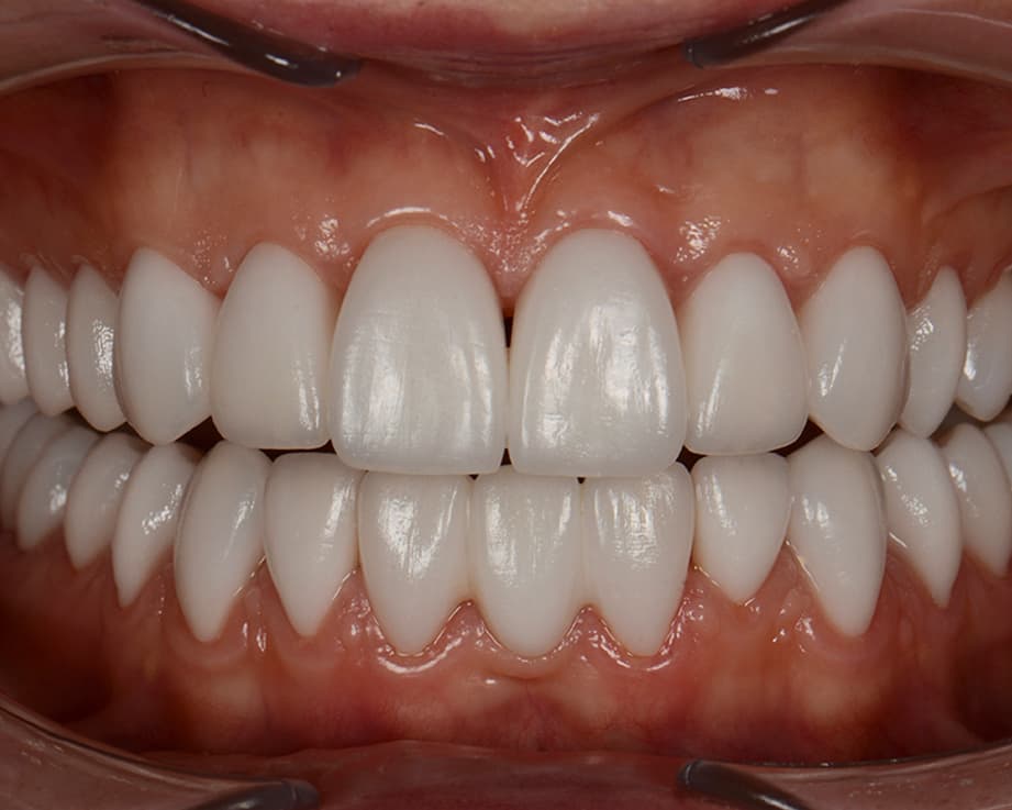 Пресс-керамика E.max