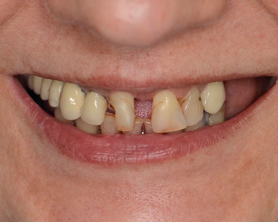 Протезирование All-on-6, цирконий