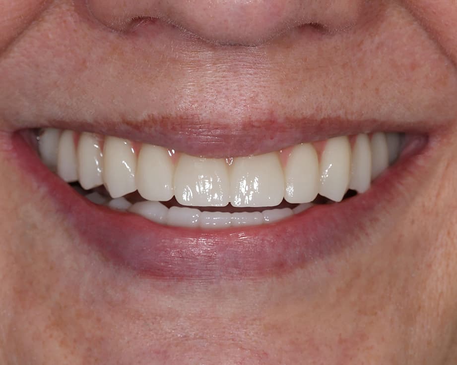 Протезирование All-on-6, цирконий