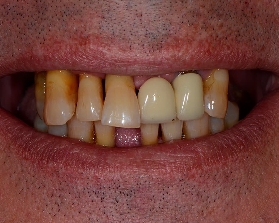 Протезирование All-on-6, цирконий