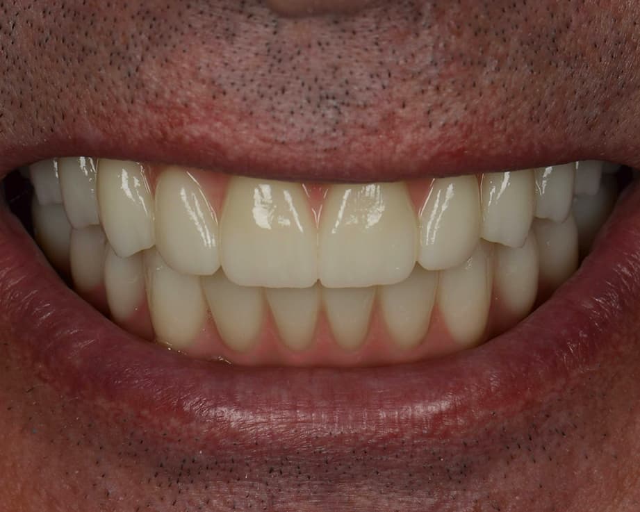 Протезирование All-on-6, цирконий